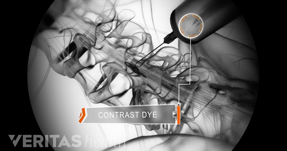 Inyeccion para hernias discales